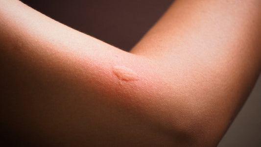 Why should you worry about a mosquito bite?